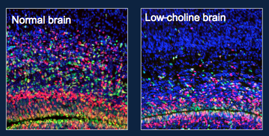 NRI Researcher Links Choline Deficiency To Impaired Brain Structure ...