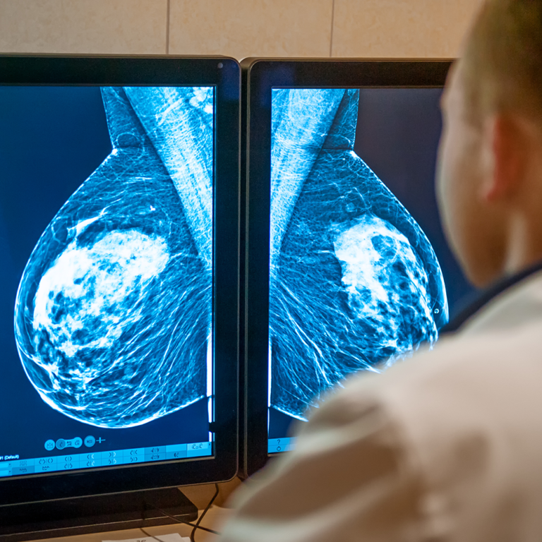 Breast Cancer Subtype Important in Deciding Impact of Folate